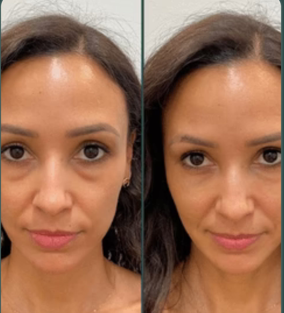 Before - Brightens dull skin